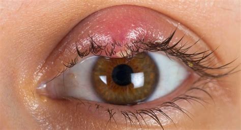 Sty Vs Chalazion Vs Hordeolum