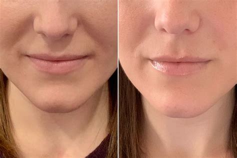 Nasolabial folds. Non-surgical treatments for a youthful look - Hush LA Medspa