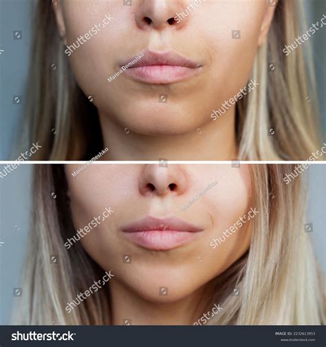355 Chin Reduction Surgery Images, Stock Photos & Vectors | Shutterstock