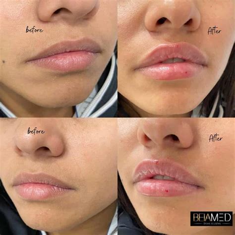 Lip Botox Injections Before And After at Francis Needham blog