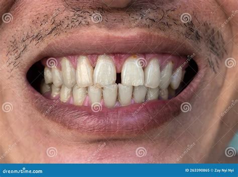 Huge Gap between the Front Teeth or Incisors. Diastema Stock Image ...