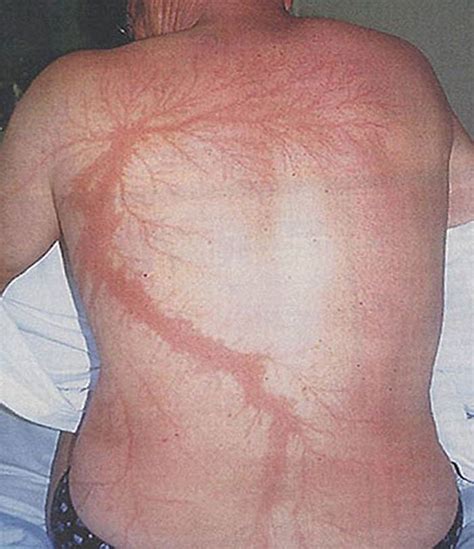 Scars after a lightning strike : r/creepy