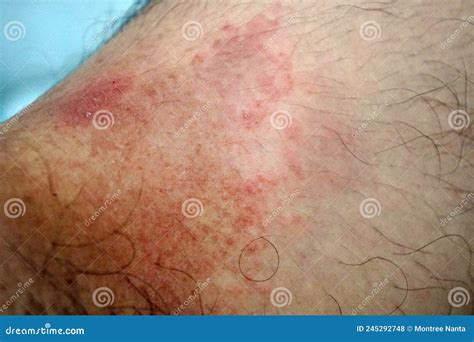 Groin Chafing Rash - How To Prevent Skin Chafing - QGBR
