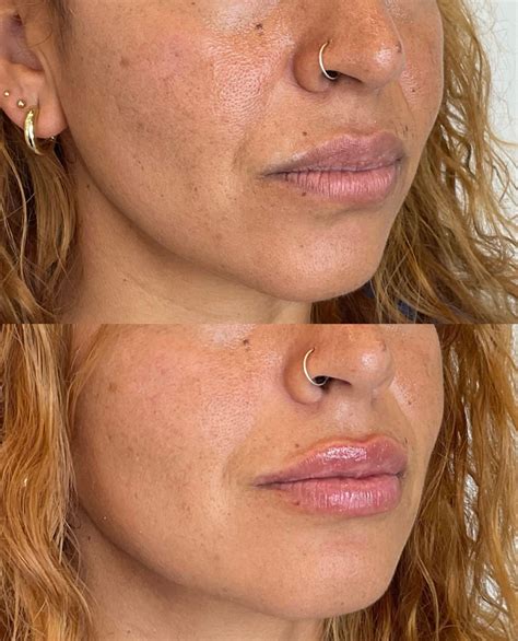 My Lips Hurt After Lip Filler at Madison Calder blog