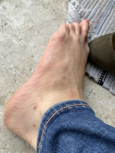 What are these spots on foot : r/DermatologyQuestions