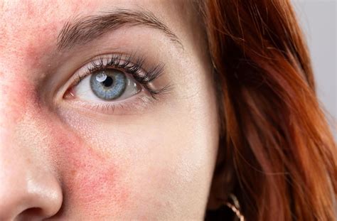 Is Rosacea Autoimmune? | Watson Dry Eye Clinic