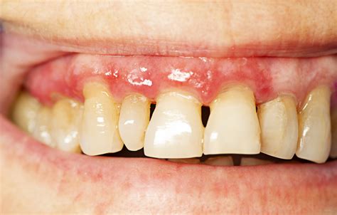 White Spots On Gums Pregnancy at Charles Gilley blog