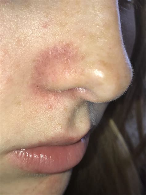 Youtube Acne On Nose Pimple Inside Nose Sinusitis