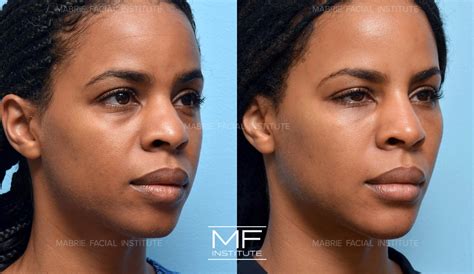 Nasolabial Folds Before and After Pictures Case 976 | San Francisco, CA | Mabrie Facial Institute