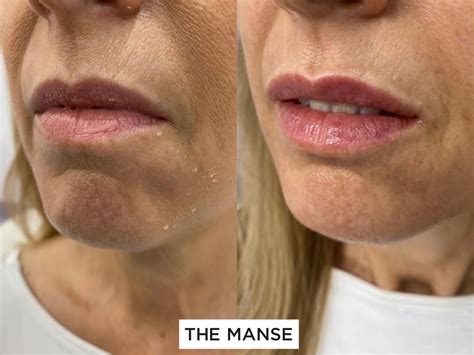 Marionette Line Filler Technique at Margaret Suarez blog