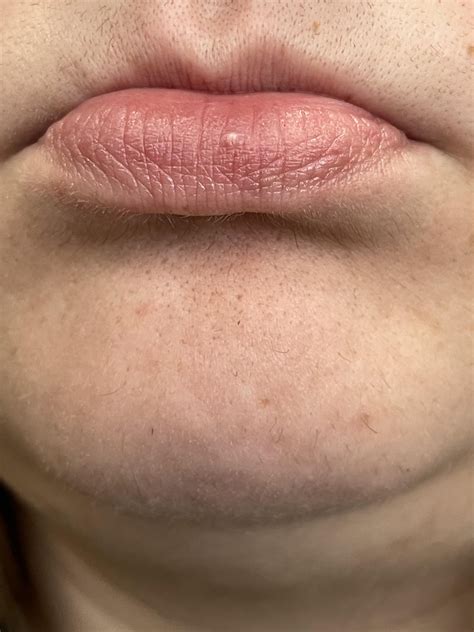 Friend has weird bump on lip, what is it? : r/DermatologyQuestions