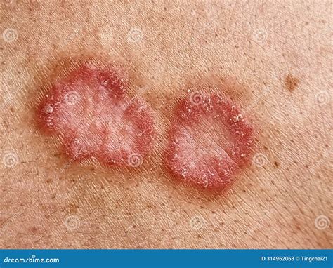 Fungal Skin Rash On Back