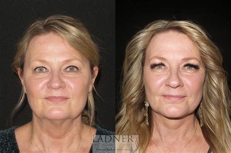 Deep Plane Facelift / Neck Lift Before and After Pictures Case 31 | Denver, CO | Ladner Facial ...