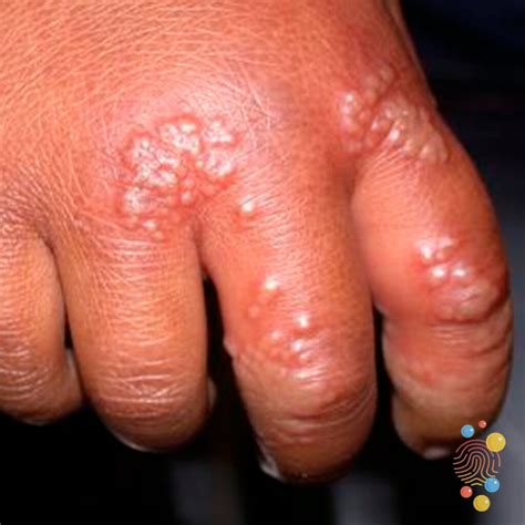 Herpes Infection On Hand