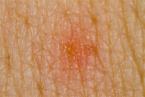 Scabies Bites