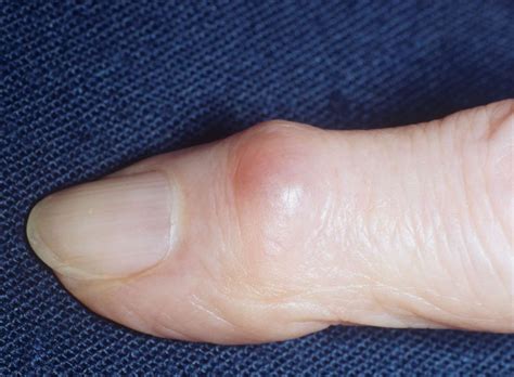 Lumps Under Your Skin - Dr. Ken Greer/Visuals Unlimited/Corbis | Rheumatoid arthritis ...