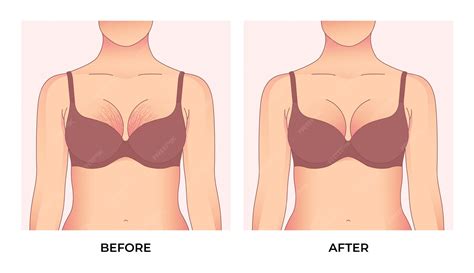 Premium Vector | Woman with stretch marks on breast. Before and after weight loss, woman body ...