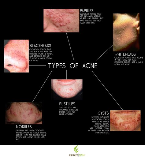How to Recognize What Kind of Acne You Have | Innate Skin | Types of acne, Acne causes, Skin ...