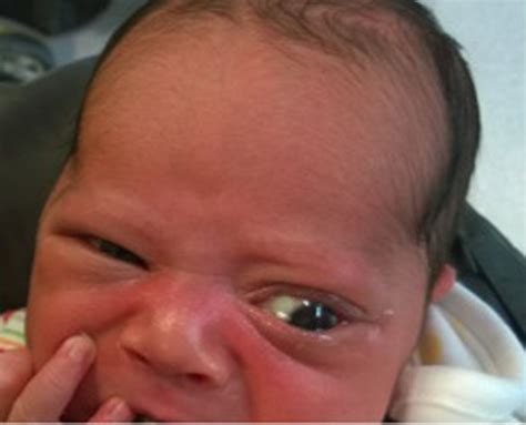 Subconjunctival Hemorrhage Newborn