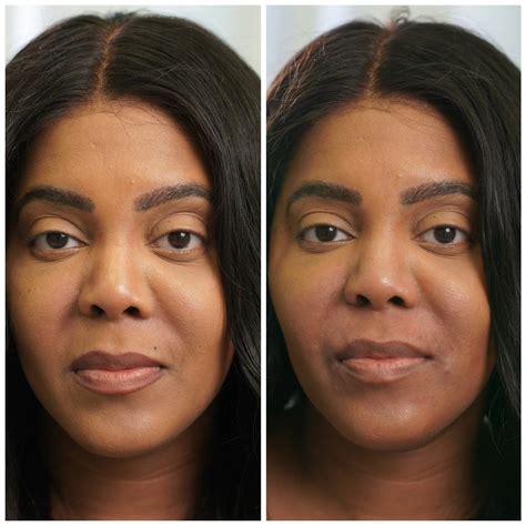 Smile Lines | Facelifts, Injectables & Lasers | Petro Facial Plastic Surgery Birmingham