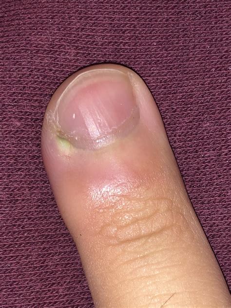 Why Is My Ingrown Fingernail Turning Green at Nathan Masterson blog