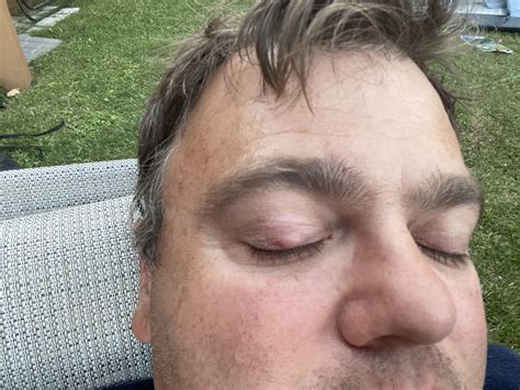 Bed Bug Bites On Eyelid