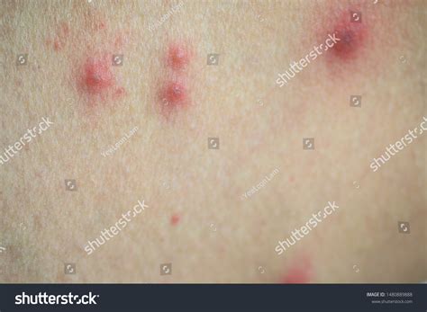 Skinbumpslumpsblisters Caused By Insect Sandfly Bitesbody Stockfoto 1480889888 | Shutterstock