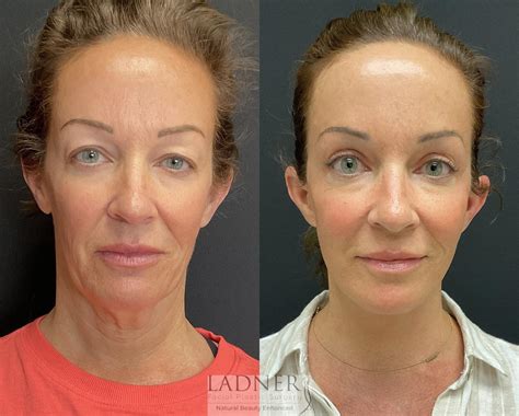What Is a Deep Plane Facelift? - Ladner Facial Plastic Surgery: Keith Ladner, MD