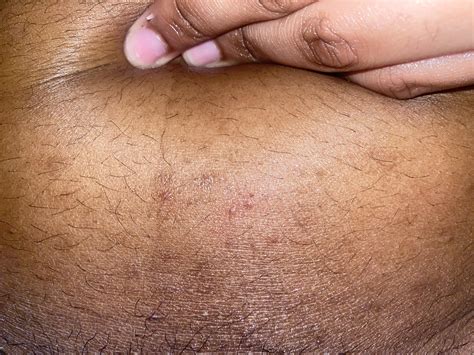 Red bumps on lower stomach : r/SkincareAddicts