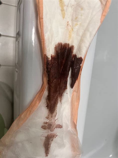 Heavy Bleeding After C Section CESAREAN SECTION: What To Expect After