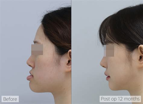 Double Jaw & V-line Surgery