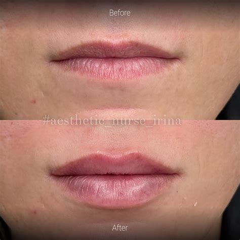 Cosmetic Treatments Before and After Gallery