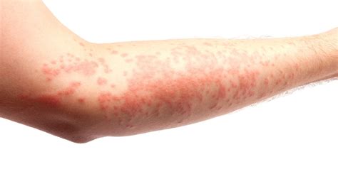 Erythema | Causes, Symptoms, and Treatments