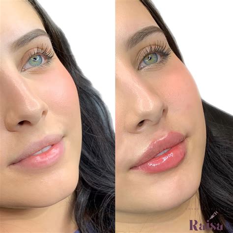 Lips filler before and after – Artofit