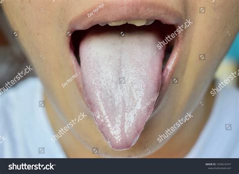 What Is The White Coating On My Tongue at Tristan Cadell blog