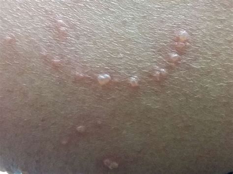 Viral Rash: 9 Types, Causes, Symptoms, and Treatment