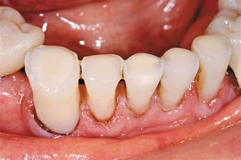 How to manage exposed dentin: a great patient service