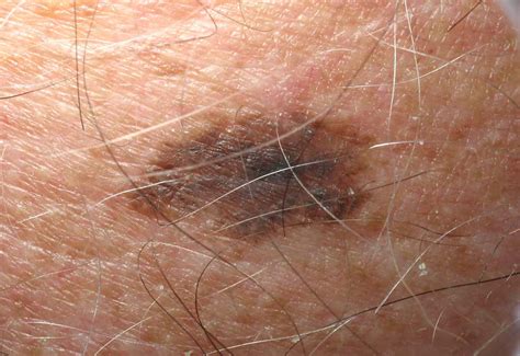 Photos of melanoma early stages | Symptoms and pictures