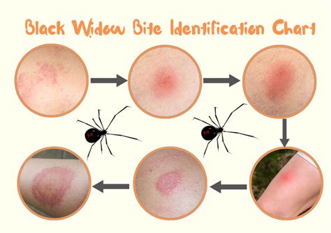 Southern Black Widow Spider Bite: Stages, Symptoms with Pictures