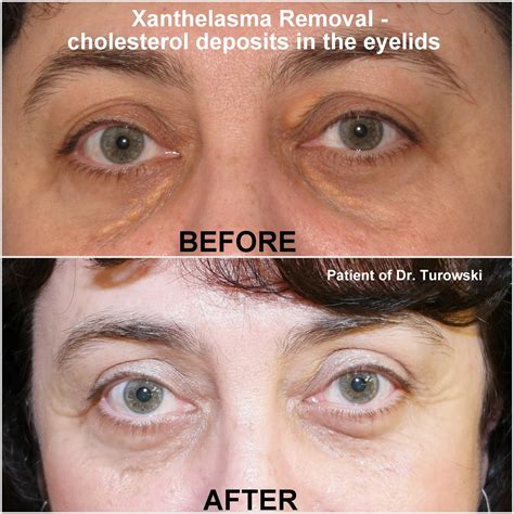 Cholesterol Under Eye at Joan Dudley blog