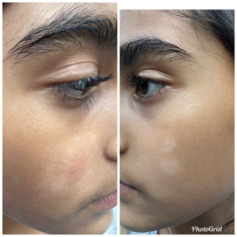 Tinea Versicolor On Face