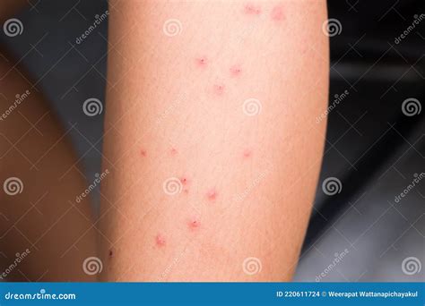 Red Allergy Pimples on the Leg Stock Photo - Image of blood, girl: 220611724