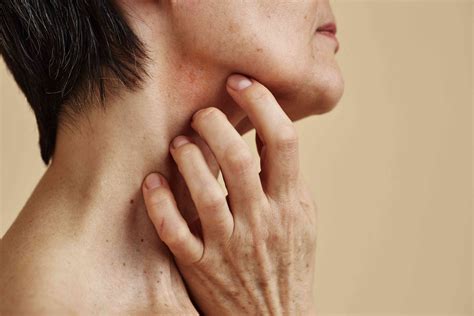 Stress Rash On Neck