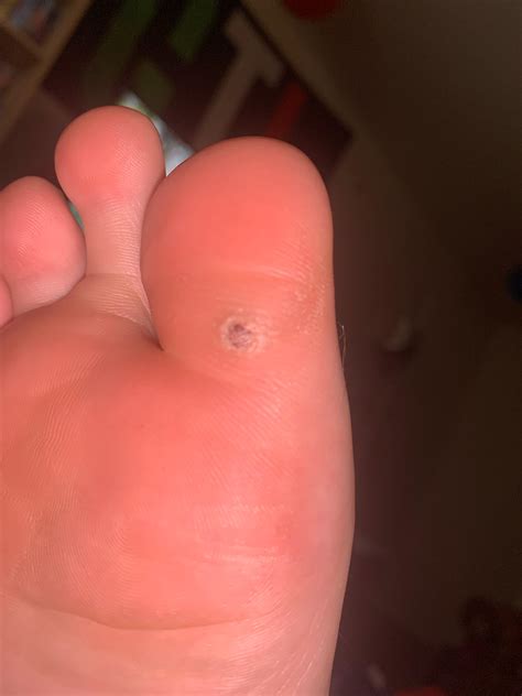 Black spot on big toe cause for concern? : r/Melanoma