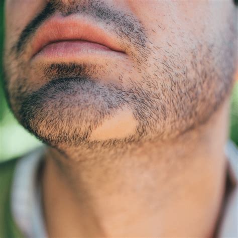 How to Fix a Patchy Beard and Grow Thicker Hair