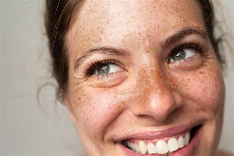 Freckles vs Moles: How to Spot the Difference