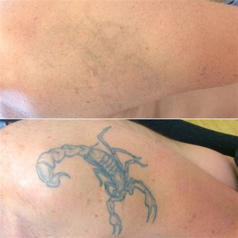 How to erase a tattoo at home?
