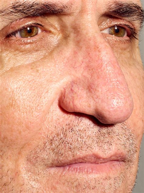 Telangiectasias Nose