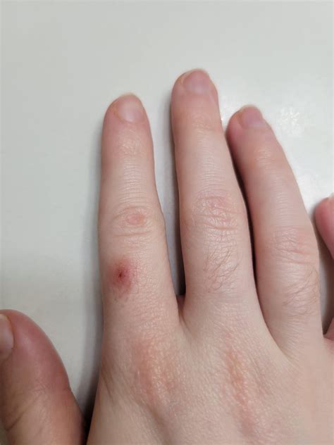 Any idea what this is? Odd redness on finger won't go away. : r ...