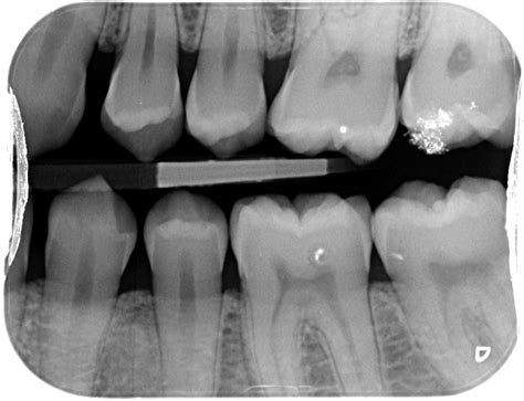 Types of Dental Radiographs and their Uses - dentalnotebook